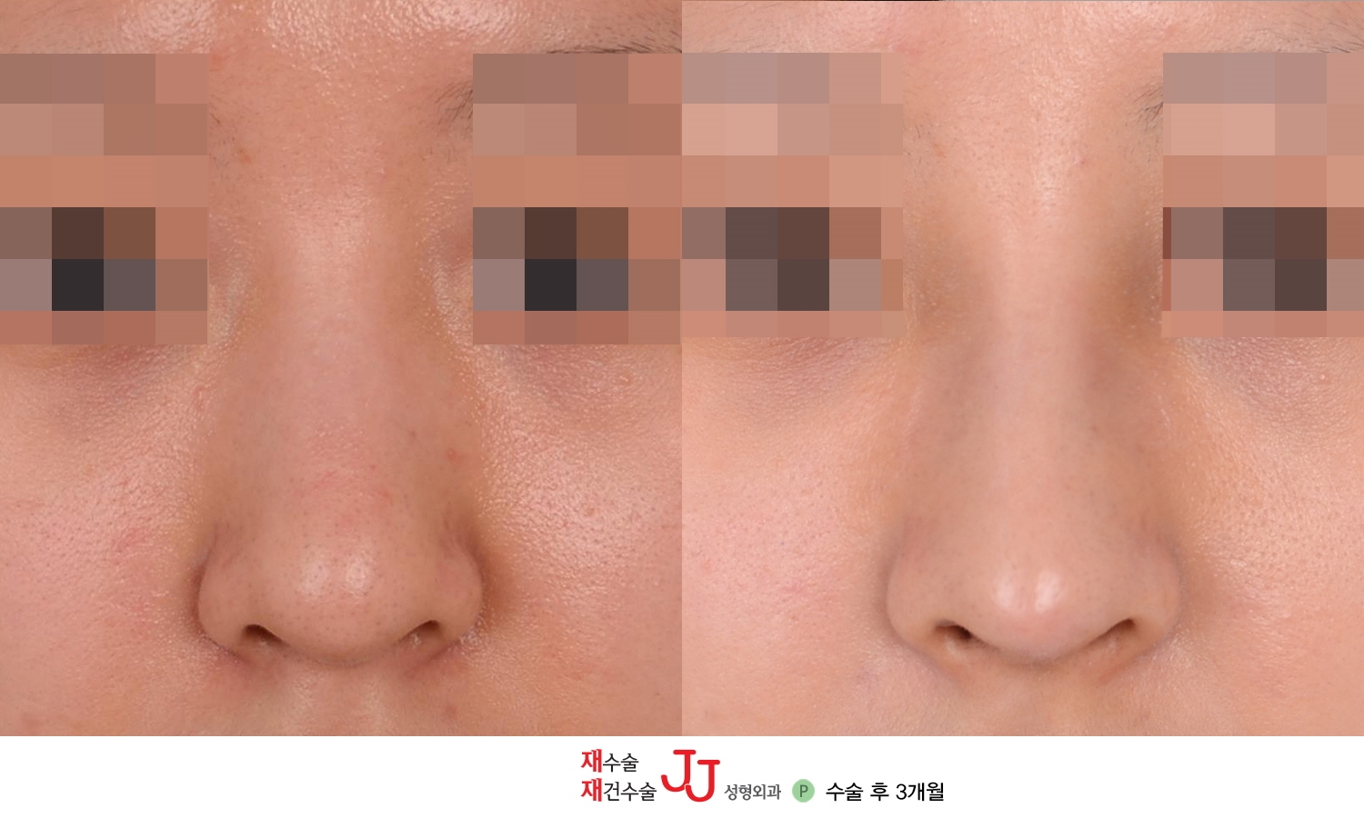 closed rhinoplasty cost closed rhinoplasty cost