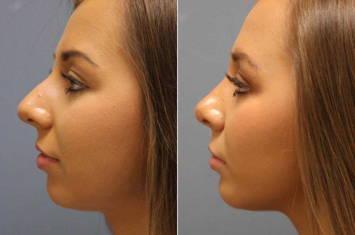 closed rhinoplasty cost closed rhinoplasty cost